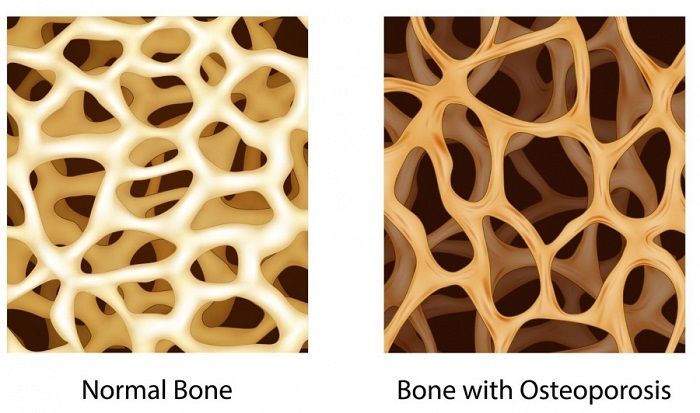 osteoporosis images