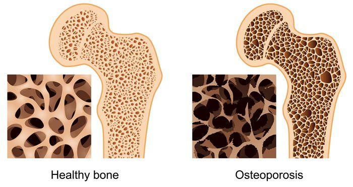 osteoporosis pictures