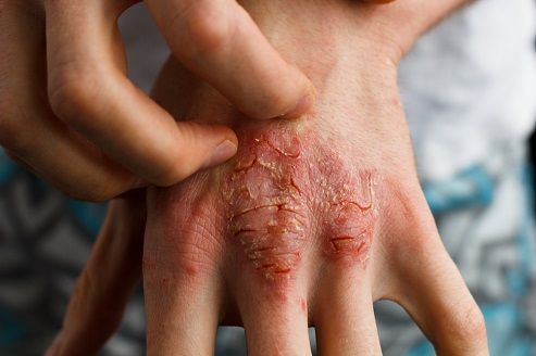 Psoriasis Treatment in India in hindi