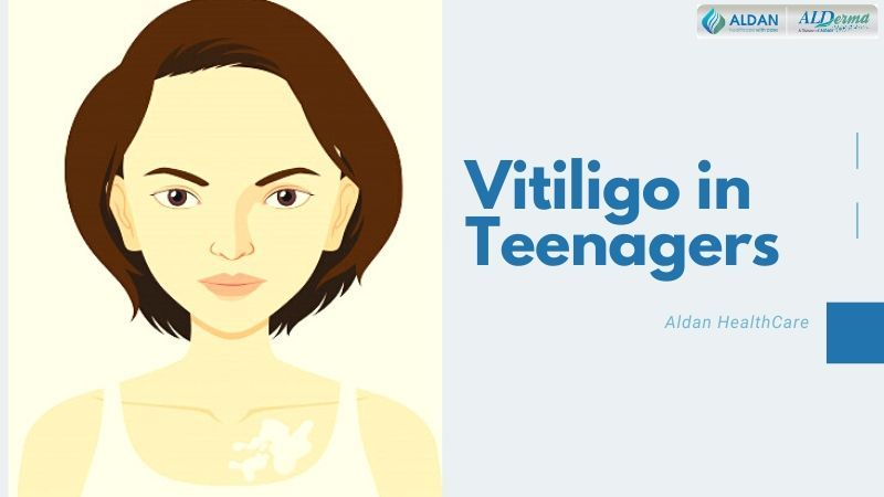 Vitiligo in Teenagers