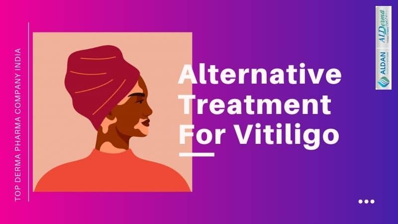 Alternative Treatment for Vitiligo