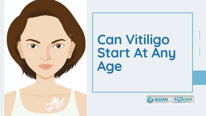 Can Vitiligo Start At Any Age