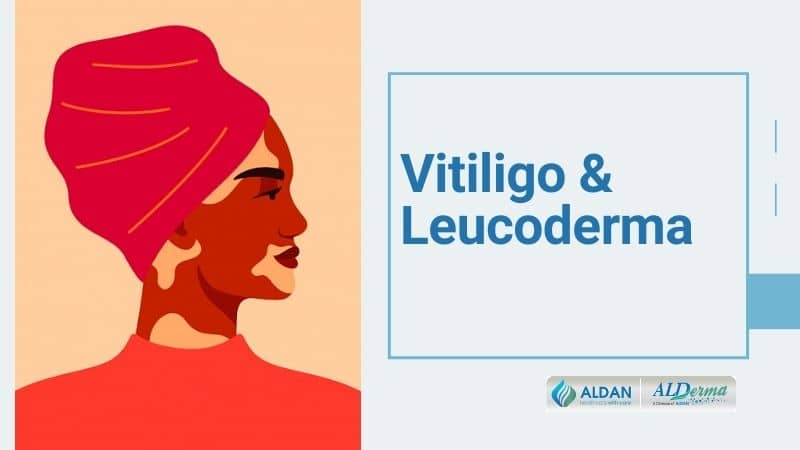 Vitiligo and Leucoderma