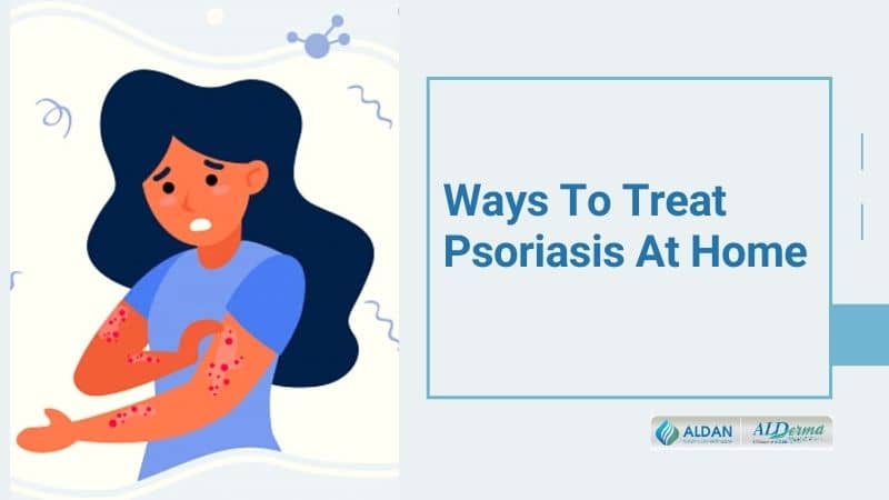 Ways To Treat Psoriasis At Home