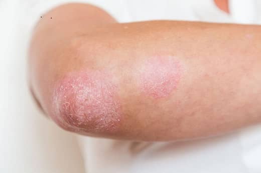 Psoriasis Types Images