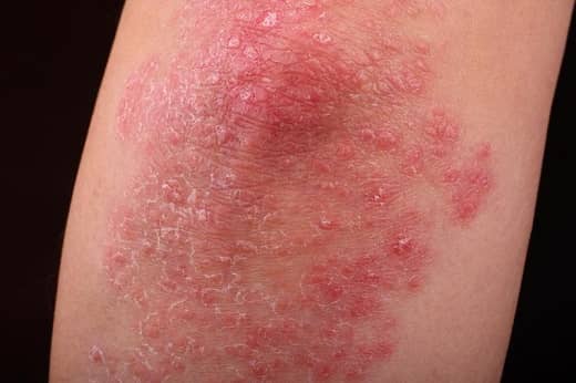 Types of Psoriasis Pictures