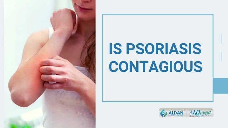 is psoriasis contagious