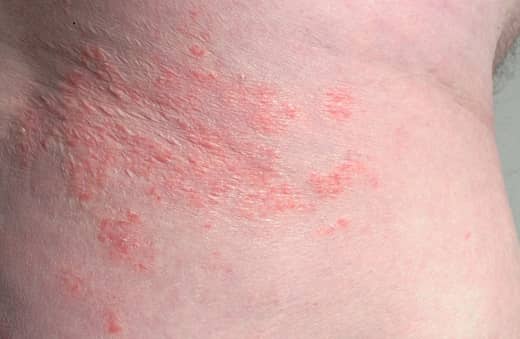 psoriasis-on-skin