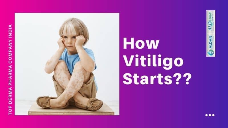 How Vitiligo Starts