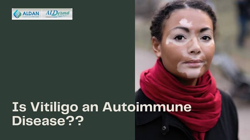 Is Vitiligo an Autoimmune Disease