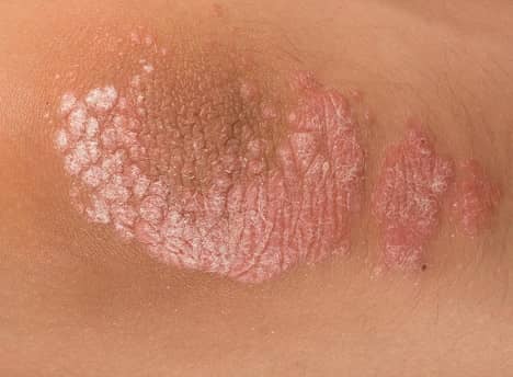 Types of Psoriasis Pictures