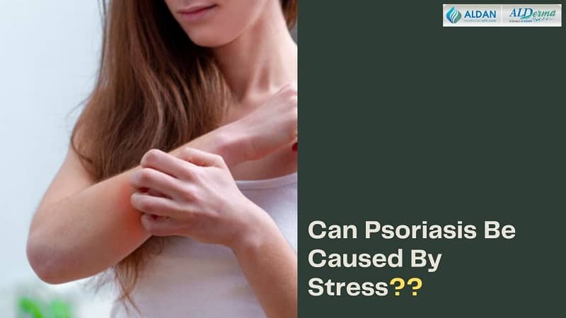 can psoriasis be caused by stress