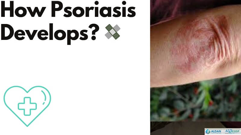 How Psoriasis Develops