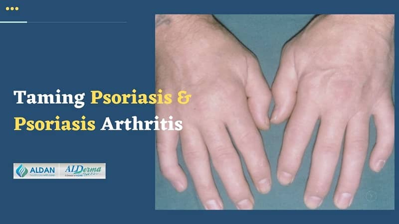 Taming Psoriasis and Psoriasis Arthritis